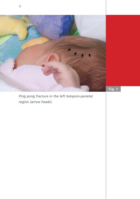 Neonatal ping pong fracture - Swiss Society of Neonatology