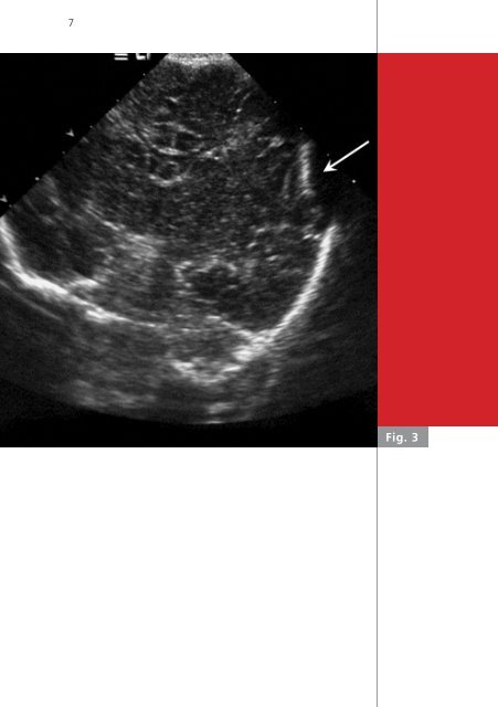 Neonatal ping pong fracture - Swiss Society of Neonatology