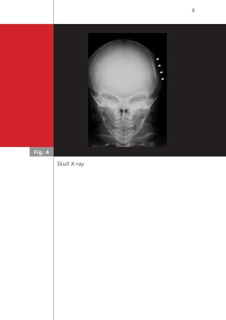 Neonatal ping pong fracture - Swiss Society of Neonatology