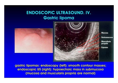 AA.Gastric C II 06. ppt