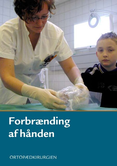 Forbrænding af hånden