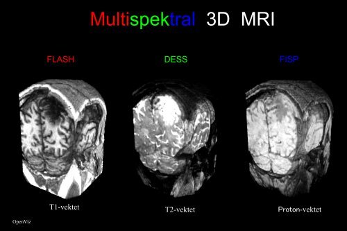 Arvid Lundervold: Introduksjon til MRI