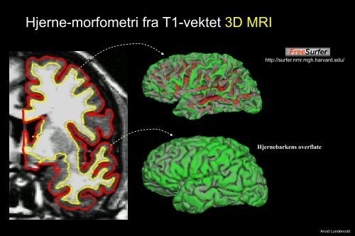 Arvid Lundervold: Introduksjon til MRI