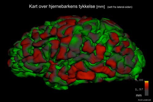 Arvid Lundervold: Introduksjon til MRI