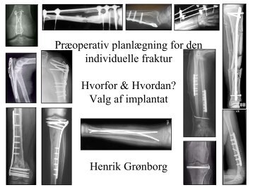 Præoperativ planlægning for den individuelle fraktur Hvorfor ...