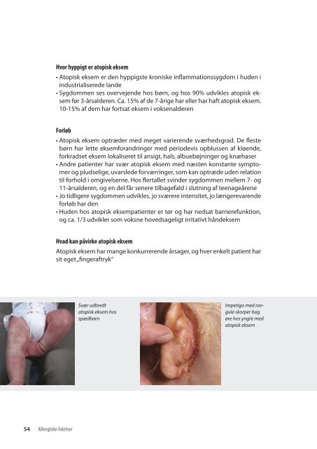 Allergiske lidelser – Håndbog om udredning og ... - APO Danmark