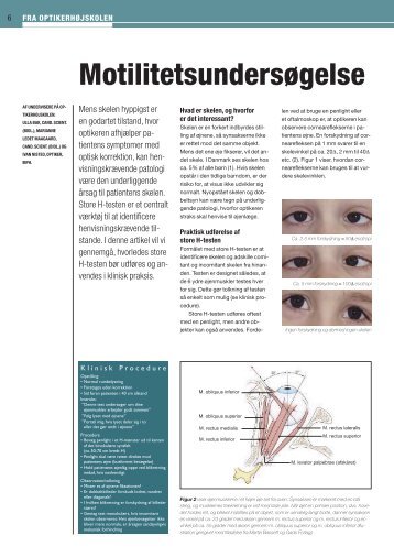 Motilitetsundersøgelse - Danmarks Optikerforening