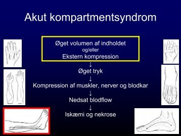 Akut kompartmentsyndrom