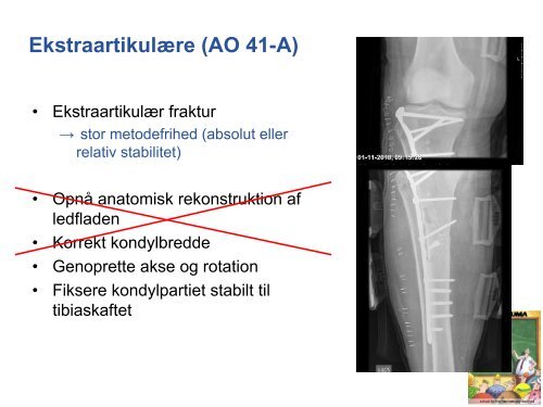 Tibiaplateau-frakturer