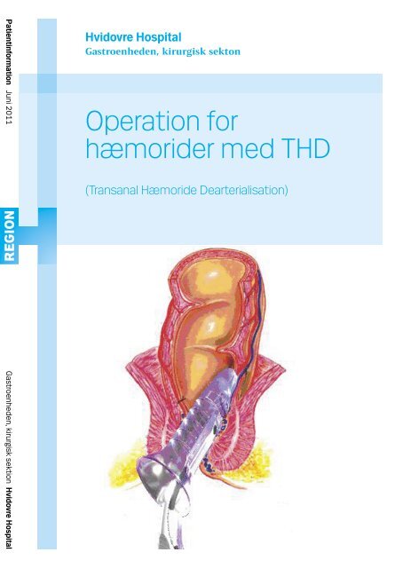 Operation for hæmorider med THD