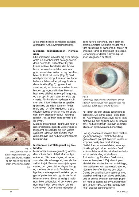 Cancer i Øjenregionen - Danmarks Optikerforening