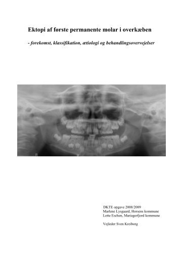 Ektopi af første permanente molar i overkæben