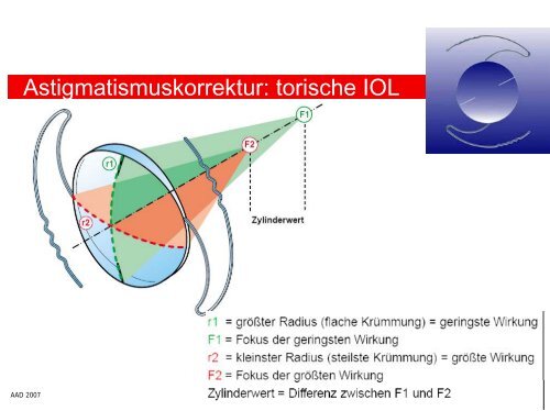 Astigmatismuskorrektur: torische IOL