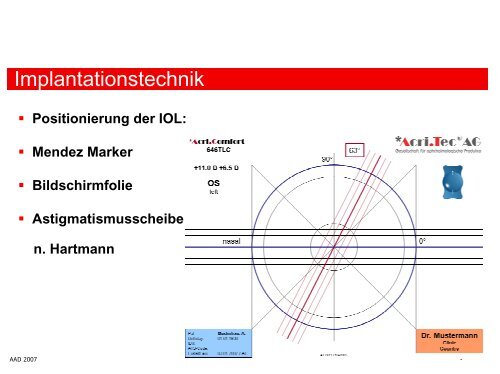 Astigmatismuskorrektur: torische IOL