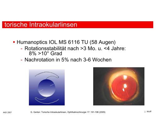 Astigmatismuskorrektur: torische IOL