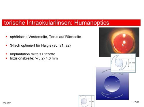 Astigmatismuskorrektur: torische IOL