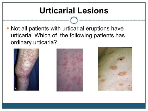 Urticaria - Dermatology