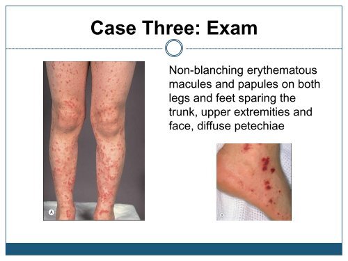 Purpura, Petechiae and Vasculitis - Dermatology