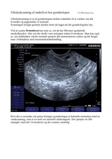 Ultralydscanning af underlivet - gynækolog christine felding