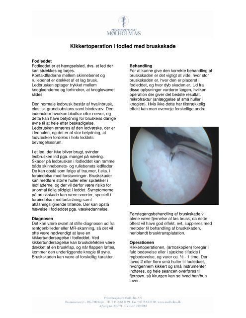 Kikkertoperation i fodled med bruskskade - Privathospitalet Mølholm