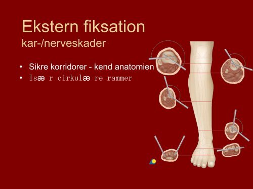 Ekstern fiksation