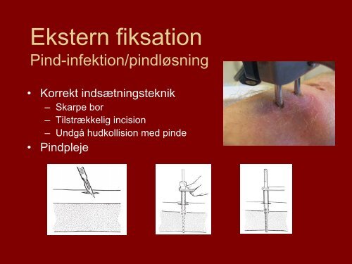 Ekstern fiksation