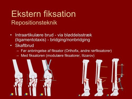 Ekstern fiksation