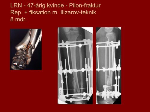 Ekstern fiksation