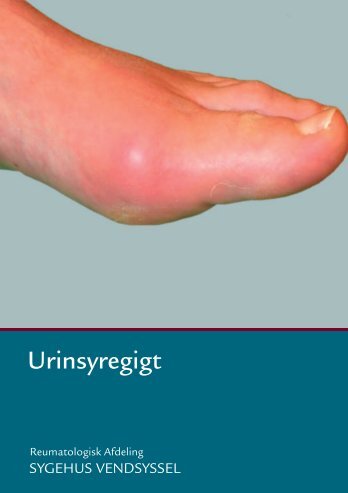 Urinsyregigt information - Sygehus Vendsyssel