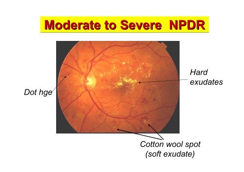 Diabetic Retinopathy (DR)