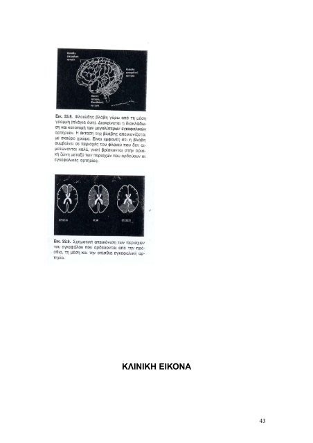 υποξικη – ισχαιμικη εγκεφαλοπαθεια