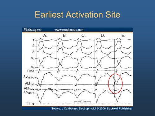 Ideopathic Ventricular Tachycardia: The Usual and Unusual