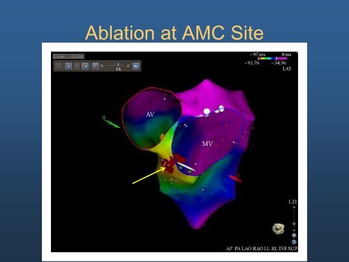 Ideopathic Ventricular Tachycardia: The Usual and Unusual