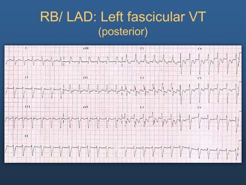 Ideopathic Ventricular Tachycardia: The Usual and Unusual