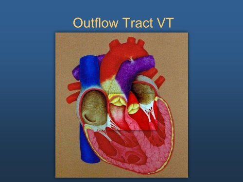 Ideopathic Ventricular Tachycardia: The Usual and Unusual