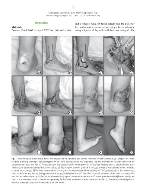 Lateral Calcaneal Artery Adipofascial Flap for Reconstruction of the ...