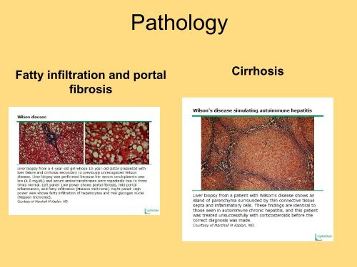 28 Wilson's Disease