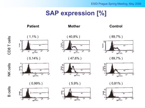 X-linked lymphoproliferative disease Case report