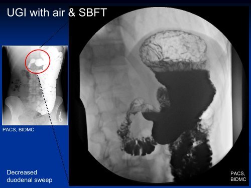 A Case of Incomplete Intestinal Malrotation in an Adult