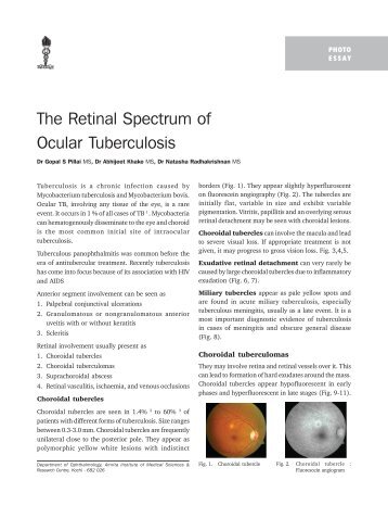 The Retinal Spectrum of Ocular Tuberculosis - KSOS