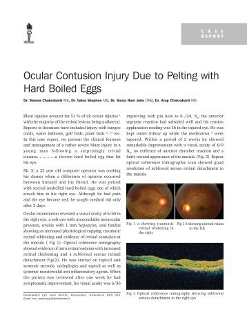 Ocular Contusion Injury Due to Pelting with Hard Boiled Eggs - KSOS