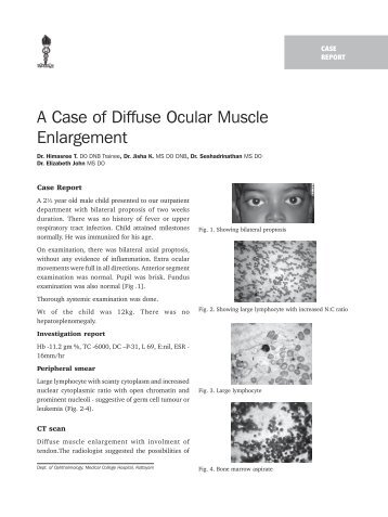 A Case of Diffuse Ocular Muscle Enlargement - KSOS