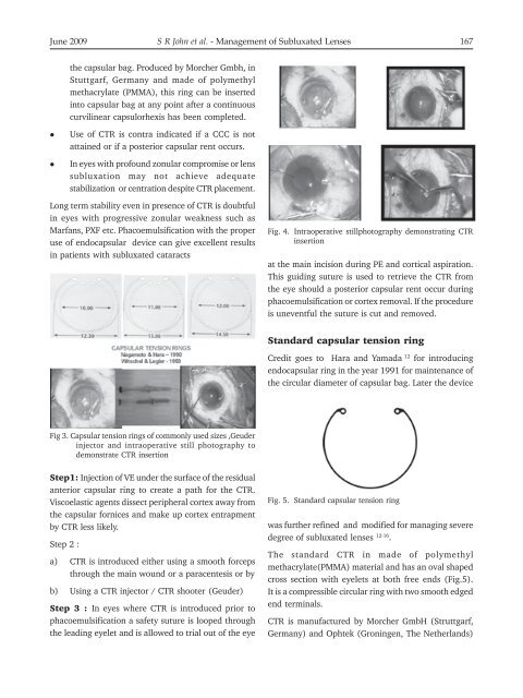 Management of Subluxated Lenses - KSOS