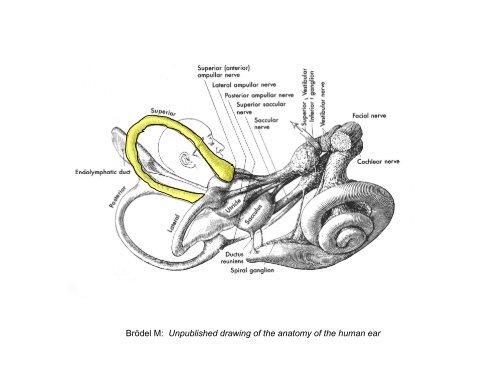 Superior Semicircular Canal Dehiscence - Stanford Hospital & Clinics