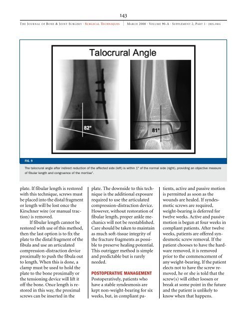 Extraperiosteal Plating of Pronation-Abduction Ankle Fractures