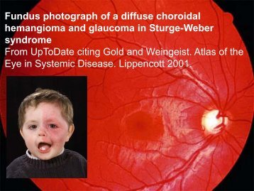 Fundus Photograph Of A Diffuse Choroidal Hemangioma And