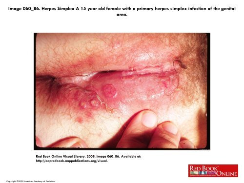 Human Herpes viruses (HHV)