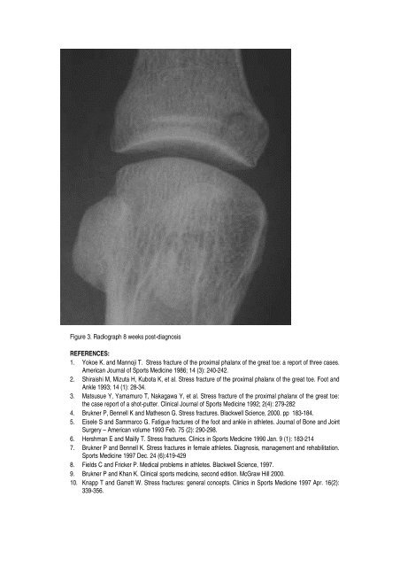 An unusual stress fracture of the proximal phalanx of the great toe: A ...