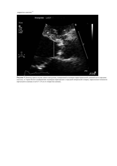 Echocardiographic Assessment of Valve Stenosis: EAE/ASE ...