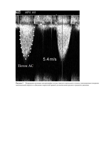 Echocardiographic Assessment of Valve Stenosis: EAE/ASE ...